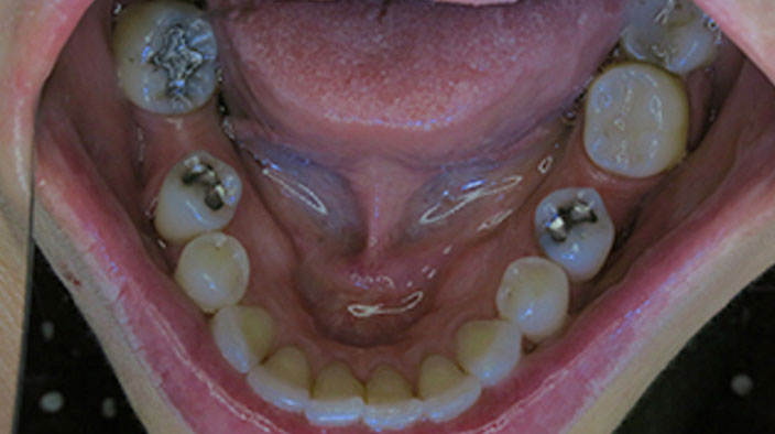 Biological Dentistry - Before Treatment