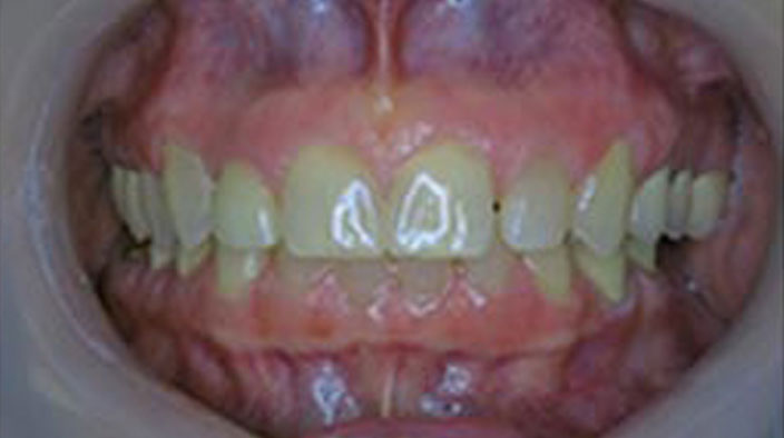 Dental Implants - After Treatment