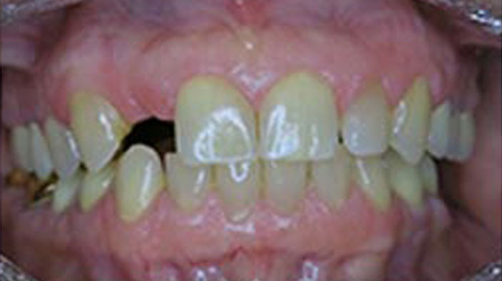 Dental Implants - Before Treatment