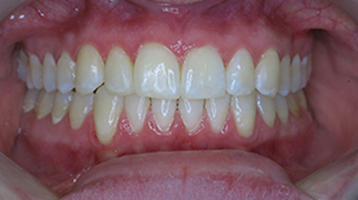 Invisalign - After Treatment 1