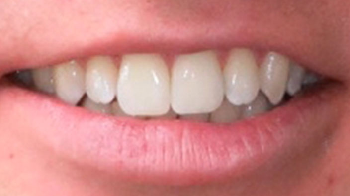 Invisalign - After Treatment 2