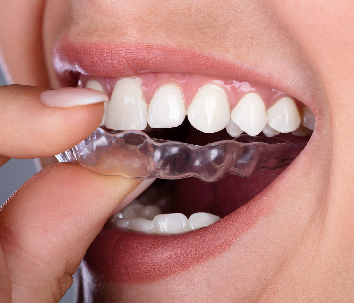 Thornhill Invisalign (Clear Braces) - Dentistry For You